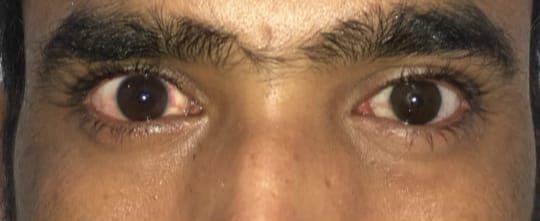 Pthisical Eye After